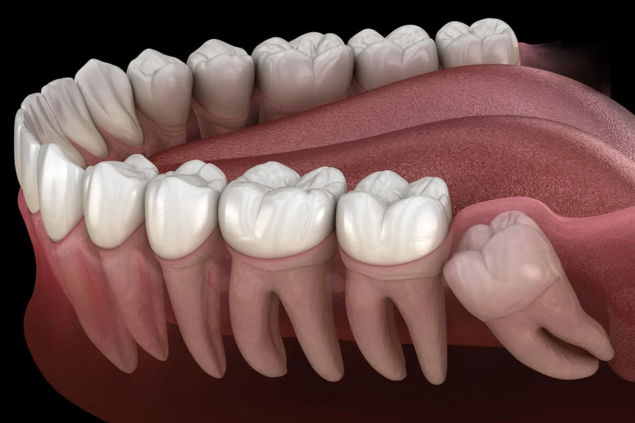 Impacted Tooth Extraction